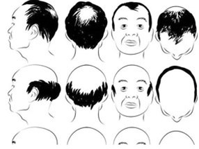 在南陽，選擇種植頭發(fā)價格怎么說？