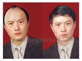 怎樣治療脫發(fā)？男士治療脫發(fā)小秘方
