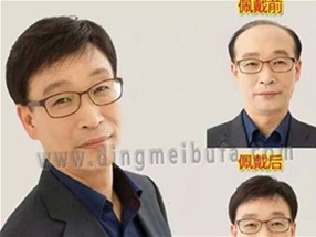 男士補發(fā)價格一般受哪些因素影響呢？